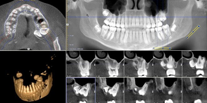 3D Απεικόνιση CBVT/CBCT